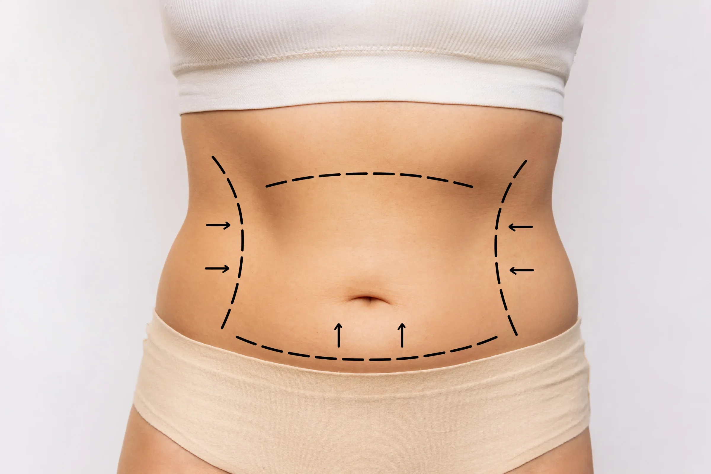 Liposuction